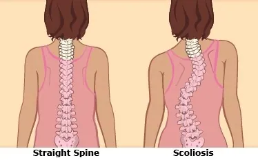  Scoliosis